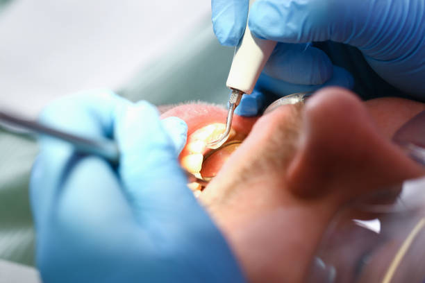 Best Broken or Cracked Tooth Emergency Dentist in Abingdon, VA