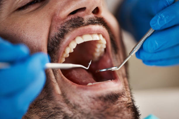 Best Emergency Root Canal Treatment in Abingdon, VA